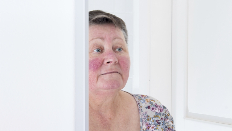 röd näsa rosacea röd näsa rosacea